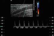 Color Doppler ultrasound for evaluation of vasomotor activity in patients with carpal tunnel syndrome